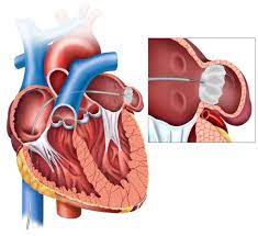 Watchman Surgery: A Minimally Invasive Solution to Reduce Stroke Risks post thumbnail image