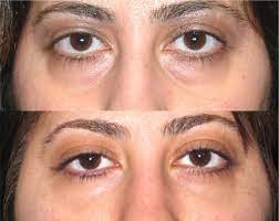 Santa Barbara’s Secret to Youthful Eyes: Experience Blepharoplasty Excellence post thumbnail image