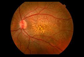 Grow older-related Macula Damage Pharmacist Near You post thumbnail image