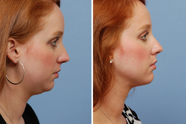 Neck Liposuction: Contouring for a Defined Jawline post thumbnail image