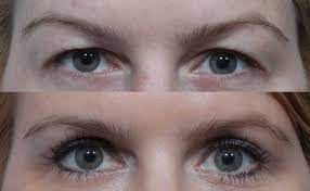 Remember to enter in the internet site to learn more about eyelid surgery Santa Barbara along with its rewards post thumbnail image