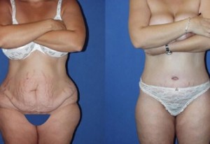 Look and Feel Your Best with a Tummy Tuck in Miami post thumbnail image
