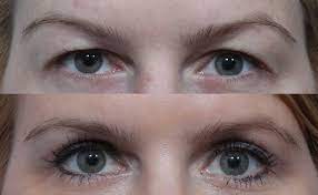 Santa Barbara’s Magic formula to Vibrant Eye: Practical experience Blepharoplasty Brilliance post thumbnail image