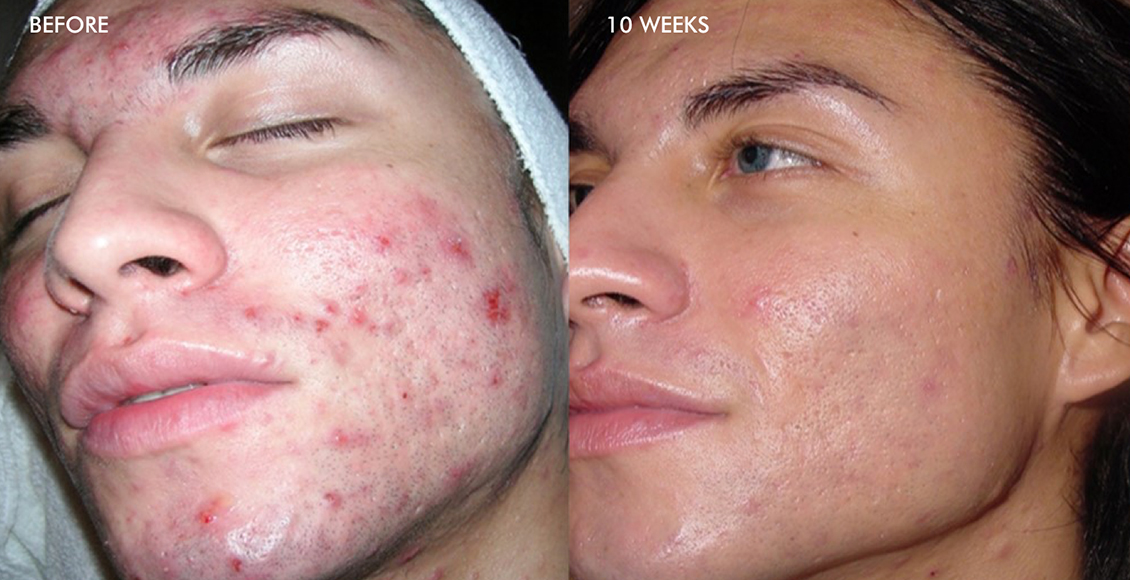 Say Farewell to Scars: Acne Scar Treatment in Edmonton post thumbnail image