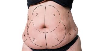 Beyond Perfection: The Miami Oasis for Abdominoplasty Mastery post thumbnail image